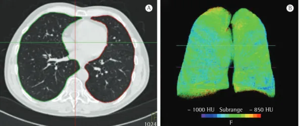 Figura 1 - TC de um paciente de 83 anos de idade com índice de enfisema de 6,4%. Em A, imagem de TC  axial mostrando o reconhecimento automático das margens do pulmão pelo software