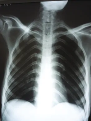 Figura 2 - Radiografia de tórax de paciente com AIDS/