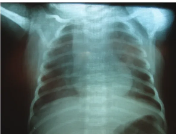 Figura 1 - Radiografia de tórax revelando opacidade  homogênea compatível com broncopneumonia