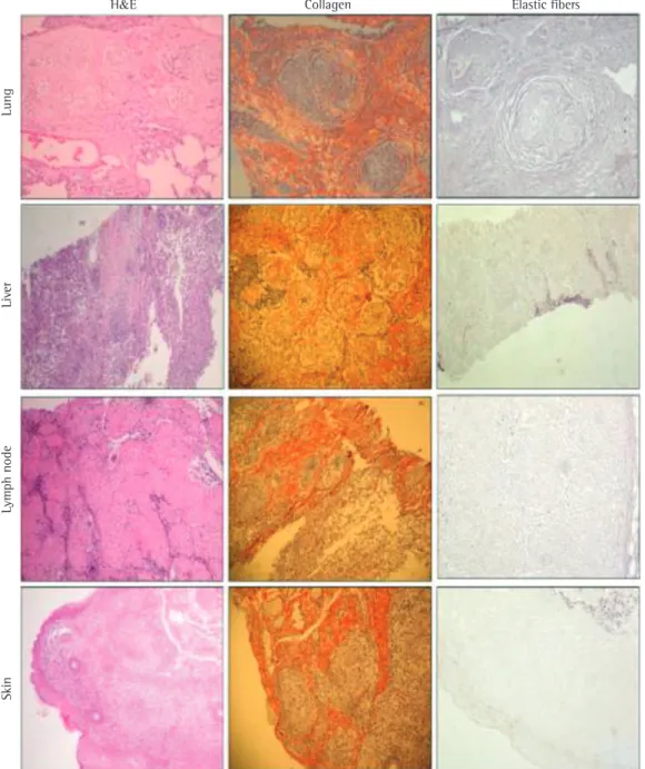Figure 1 - Lung, lymph node, liver, and skin tissue samples stained with H&amp;E, picrosirius red (collagen), and  Weigert’s resorcin-fuchsin (elastic fibers)