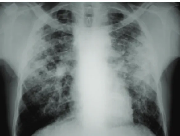 Figure 3 - Chest X-ray of a patient with tuberculous  pneumonia, revealing consolidation in the right lower  lobe.
