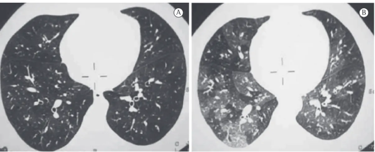 Figura 1 - Imagens de TC de tórax do caso 2 em inspiração (em A), evidenciando pulmões hiperinsuflados  e espessamento das paredes brônquicas, e em expiração (em B), evidenciando padrão em mosaico.