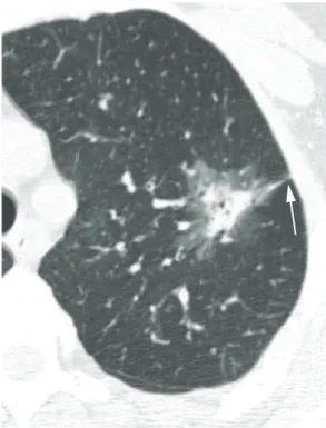 Figura 1 - Corte axial de TCAR de um paciente de  63 anos com adenocarcinoma misto com componente  bronquíolo-alveolar, demonstrando nódulo pulmonar  semissólido com margens irregulares, indentação pleural  (seta) e lucências internas (pseudocavidades).
