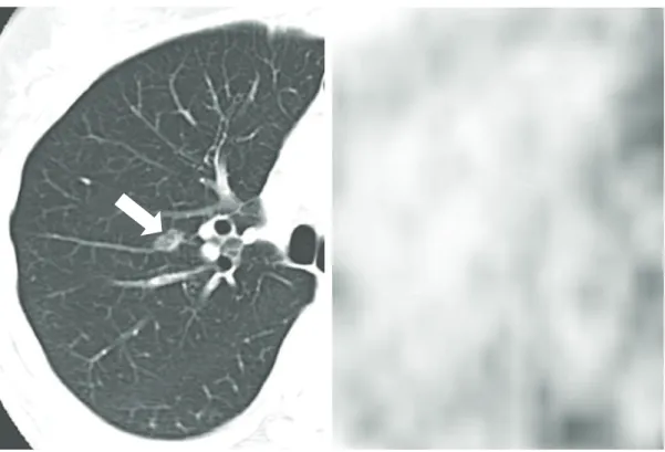 Figura 5 - Imagens tomográficas de um paciente de 57 anos com carcinoma bronquíolo-alveolar focal