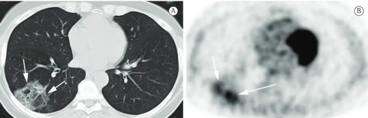 Figura 8 - Imagens de uma paciente de 49 anos, diagnosticada com adenocarcinoma misto com 50% de  componente bronquíolo-alveolar