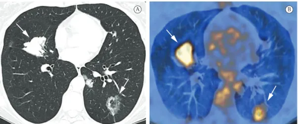Figura 12 - Imagens tomográficas de uma paciente de 43 anos com padrão difuso de carcinoma bronquíolo- bronquíolo-alveolar