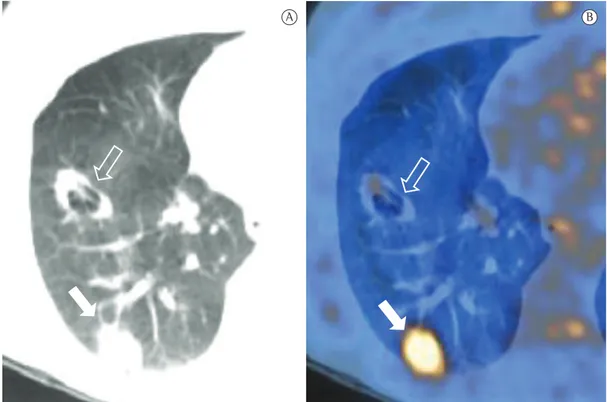Figure 4 - CT images of a 53-year-old male patient with adenocarcinoma with a bronchioloalveolar  component