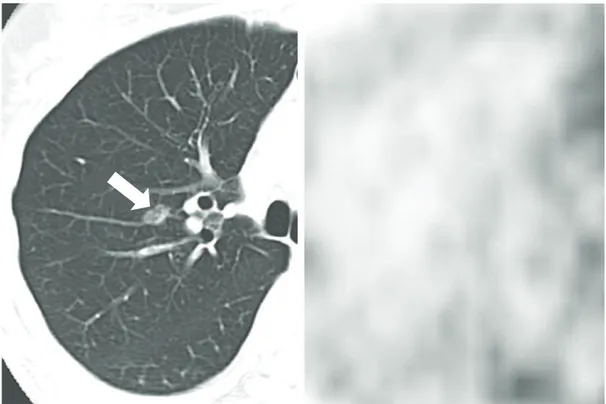 Figure 5 - CT images of a 57-year-old male patient with focal bronchioloalveolar carcinoma
