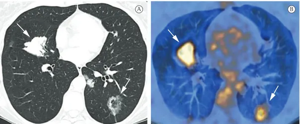 Figure 12 - CT images of a 43-year-old female patient with diffuse bronchioloalveolar carcinoma