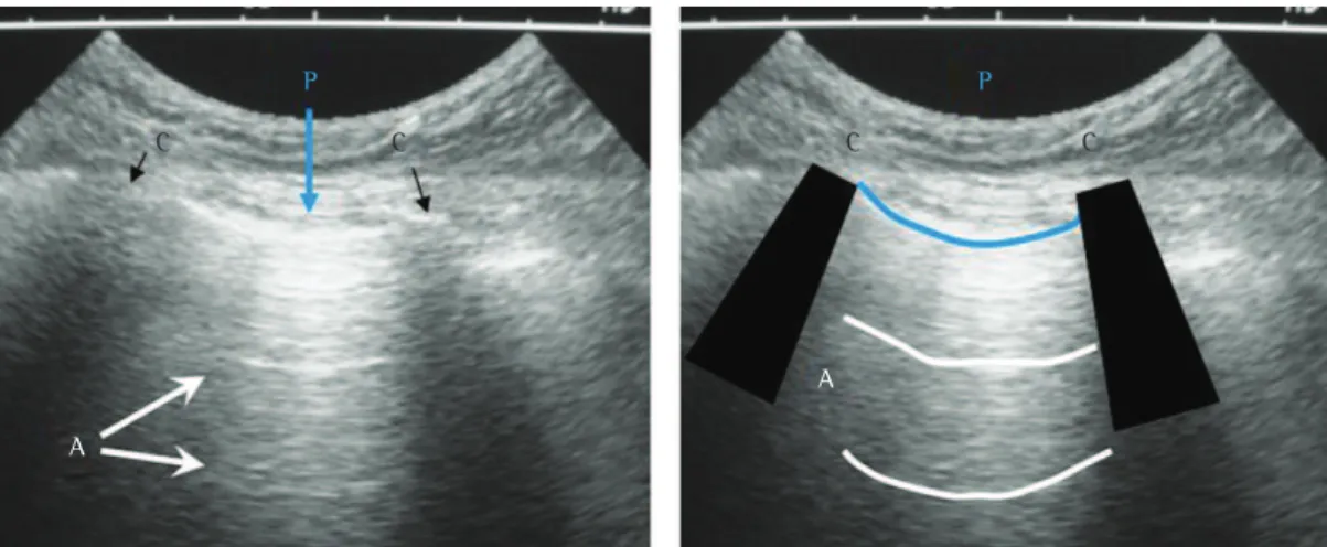 Figura 3 - Imagens de ultrassom pulmonar em pulmão normal. À esquerda, é identificado um espaço intercostal,  formado por duas costelas adjacentes (imagens escuras indicadas pelas letras C), e a linha pleural (clara,  aproximadamente 0,5 cm abaixo do nível