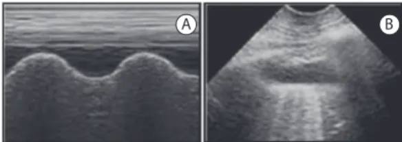 Figura 5 - Achados indicativos de derrame pleural. 