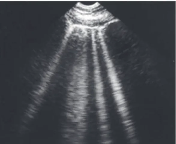 Figura 6 - Linhas B no ultrassom pulmonar. Embora  ocorra em indivíduos normais, seu número e intensidade  são diretamente proporcionais ao grau de edema  pulmonar, septal ou alveolar
