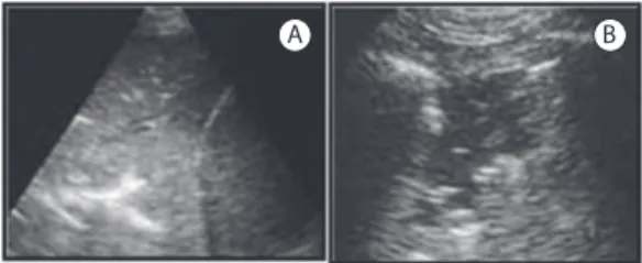 Figura 7 - Imagens de ultrassom pulmonar, indicando  perda de aeração pulmonar. Em A, sinal da hepatização: 