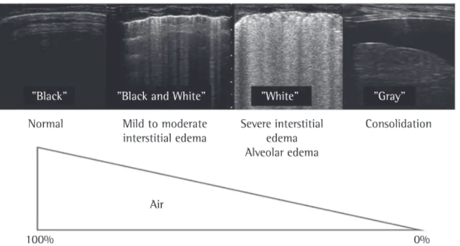 Figure 1 - Physical principles of lung ultrasound. A less aerated lung translates to easier detection of  abnormalities by the method