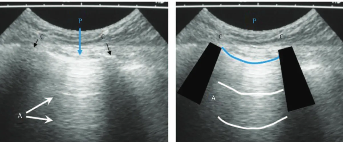 Figure 3 - Ultrasound images of a normal lung. In the figure on the left, note an intercostal space, formed  by two adjacent ribs (dark images indicated by letter C), and the pleural line (light, approximately 0.5 cm  below the ribs and indicated by letter