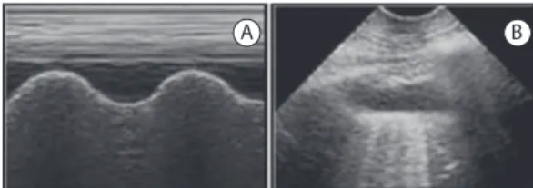 Figure 5 - Findings indicative of pleural effusion. In  A, motion-mode ultrasound showing a hypoechoic  (dark) image