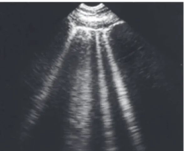 Figure 6 - B-lines on lung ultrasound. Although  B-lines are seen in normal individuals, the number  and intensity of B-lines are directly proportional to  the degree of pulmonary, septal, or alveolar edema