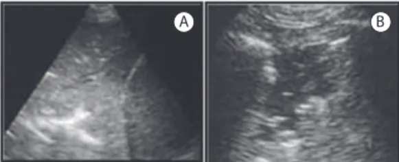 Figure 7 - Lung ultrasound images showing loss of  lung aeration. In A, the tissue-like sign, i.e., intercostal  space with the presence of lung parenchyma and  diaphragm (curved light line) on a solid organ