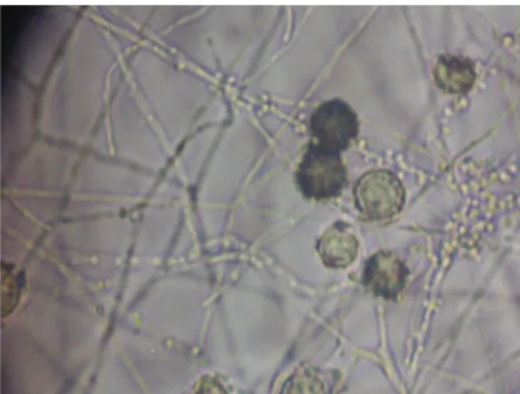 Figure 3 - Microscopic examination of BAL fluid  culture: filaments, macroconidia, and microconidia  of  Histoplasma capsulatum .