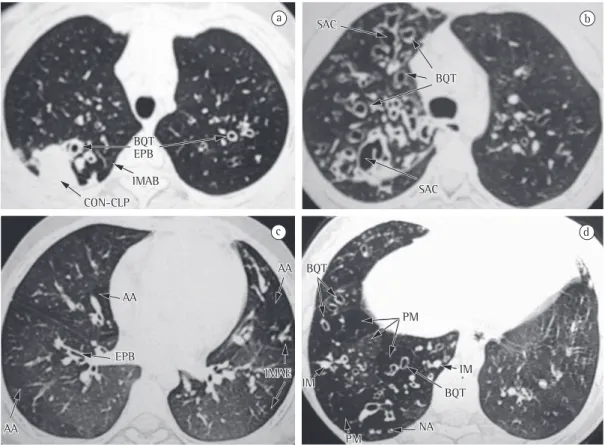Figura 1 - Imagens de TCAR. Em a, presença de bronquiectasia (BQT), espessamento da parede brônquica  (EPB), impactação mucoide do tipo árvore em brotamento (IMAB) e consolidação/colapso (CON-CLP)