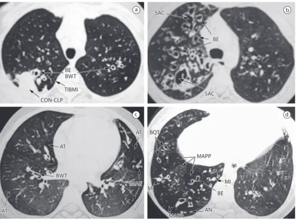 Figure 1 - HRCT scans. In A, presence of bronchiectasis (BE), bronchial wall thickening (BWT), tree-in-bud  mucoid impaction (TIBMI), and consolidation/collapse (CON-CLP)