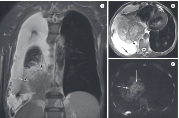 Figura 2 - Em A, imagem de ressonância magnética coronal ponderada em T2 mostrando um tumor com  baixa intensidade de sinal no pulmão direito e atelectasia com alta intensidade de sinal no lobo inferior direito  do pulmão