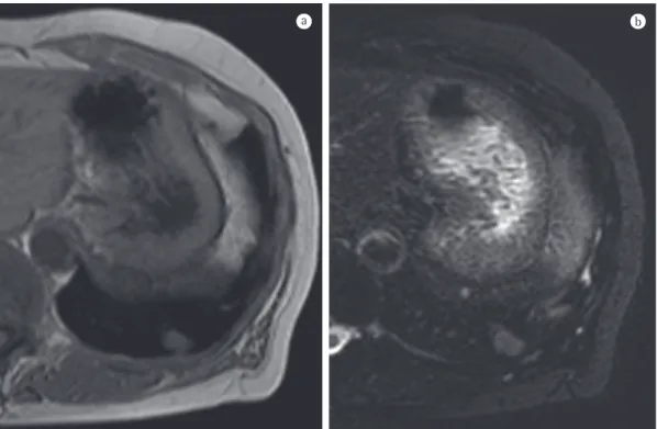 Figure 1 - In a, axial CT scan showing a pulmonary nodule, with lobulated margins, in the left lower lobe of  the lung