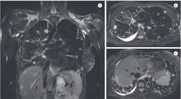 Figure 4 - In a, coronal T2-weighted magnetic resonance image with fat saturation of a patient with a lung  tumor, showing metastatic nodules with high signal intensity in the lung parenchyma (arrows)