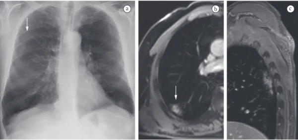 Figure 8 - In a, chest X-ray showing a suspicious opacity in the right lung (arrow). In b, axial T1-weighted  magnetic resonance image showing homogeneous segmental consolidation with air bronchogram