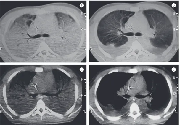 Figure 1 - Noncontrast CT scans of the chest prior to (A and C) and after (B and D) an alveolar recruitment  maneuver with sustained high pressure