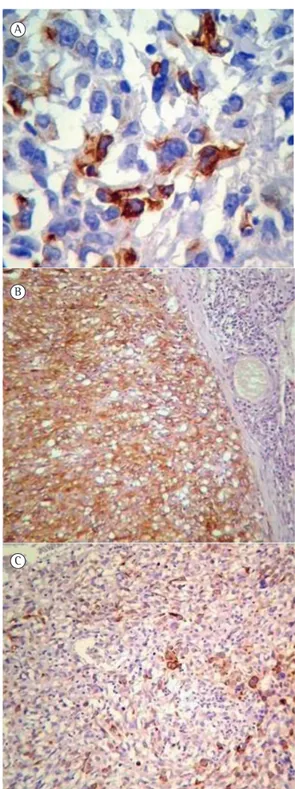 Figure 1 - Photomicrographs of pathological and  immunohistochemical studies. In A, pan-cytokeratin  cytoplasmic positivity of the tumor cells (AE1/AE3  immunostaining; magnification, ×400)