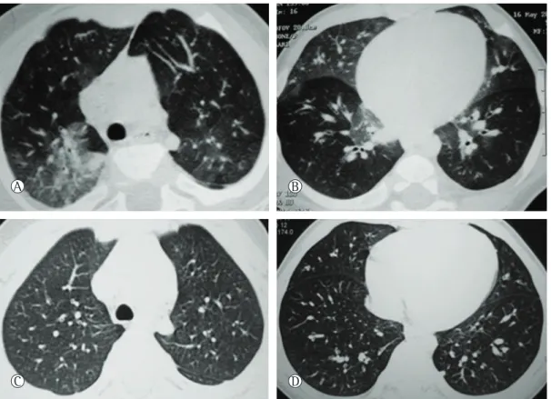 Figure 1 - In A and B, HRCT scans of a 5-month-old patient showing mosaic attenuation with geographic  ground-glass opacities in the posteromedial upper lobes, middle lobe, lingula, and lower lobes