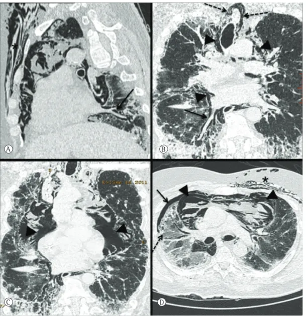 Figura 3 - Em A, reformatação sagital oblíqua de TCAR, que demonstra ar dissecando o interstício pulmonar  ao longo da veia pulmonar inferior direita (seta), até atingir o mediastino