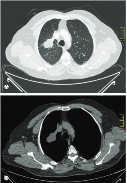 Figure 1 - Chest CT scan. In A, lung window. In B, mediastinal window. The lung mass showed no  enhancement after contrast administration, being accompanied by a slight apical displacement of the right  pulmonary hilum and by a few mediastinal lymph nodes 