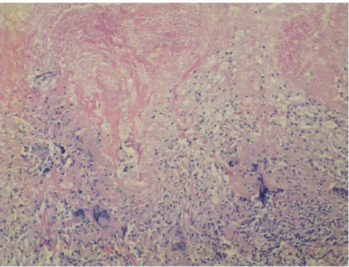 Figure 2 - Pulmonary tuberculosis. Photomicrograph (H&amp;E; magnification, ×100) showing caseous necrosis  (upper half) and granulomatous inflammatory infiltrate containing lymphocytes, epithelioid macrophages,  and numerous multinucleated giant cells (lo
