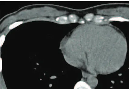 Figure 2 - CT scan of the chest performed four weeks after admission showing complete resolution of the  previous findings.