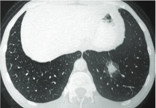 Figure 1 - A CT scan at the level of the lower lobes showing a nodule surrounded by ground-glass attenuation  (halo sign) in the left lower lobe.