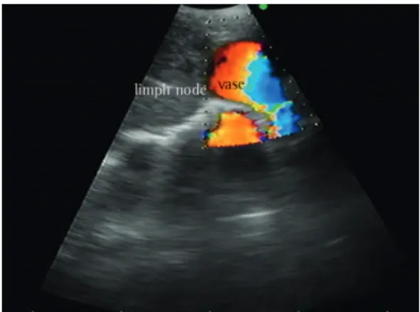 Figure 3 - Doppler ultrasound image of a lymph  node and a vessel. Courtesy of the Department of  Bronchoscopy, Heart Institute, University of São Paulo  School of Medicine  Hospital das Clínicas .