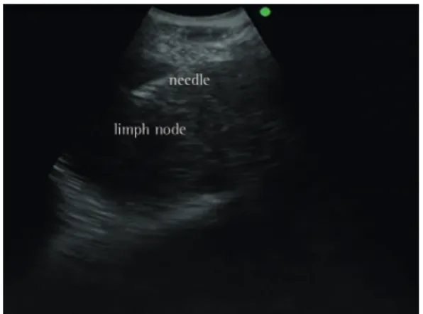 Figure 4 - Ultrasound image from lymph node fine  needle aspiration. Courtesy of the Department of  Bronchoscopy, Heart Institute, University of São Paulo  School of Medicine  Hospital das Clínicas .