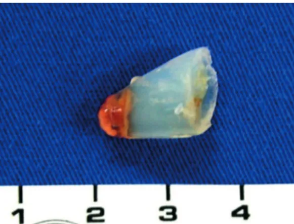Figure 6 - Paraffin block containing lymph node  aspirate. Courtesy of Dr. Cristina Mitteldorf.