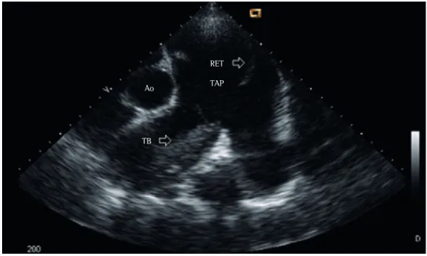 Figura 1 - Ecocardiograma transtorácico mostrando um trombo (TB) na artéria pulmonar direita e um  retalho (RET) naquele nível, que é compatível com dissecção da artéria pulmonar