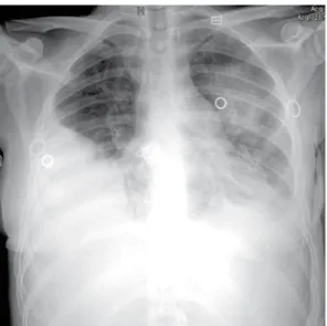 Figura 1. Radiograia de tórax mostrando derrame pleural  à direita e iniltrado pneumônico em terço médio e em lobo  inferior de hemitórax esquerdo.
