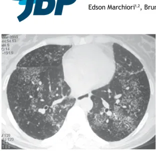 Figure 1. HRCT scan showing clusters of small nodules with  no conluence in the lower lobes of both lungs.