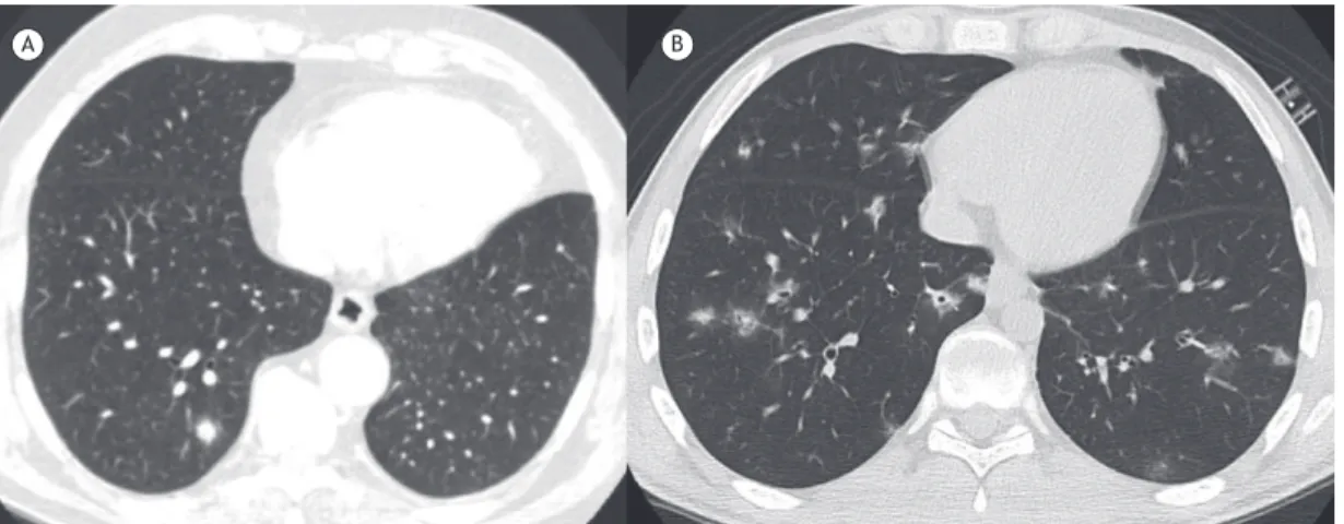 Figura 2. Em A, TC axial do tórax de um paciente imunocompetente assintomático de 54 anos de idade mostrando um  nódulo pulmonar no lobo inferior direito rodeado de áreas de opacidade em vidro fosco (o sinal do halo tomográico); o  diagnóstico inal foi de 