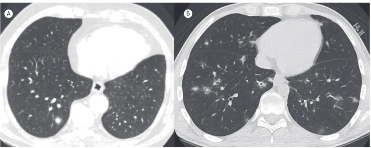 Figure 2. In A, axial CT scan of the chest of an asymptomatic, immunocompetent 54-year-old male patient, showing a  right lower lobe pulmonary nodule surrounded by areas of ground-glass opacity (the CT halo sign); the inal diagnosis  was primary adenocarci
