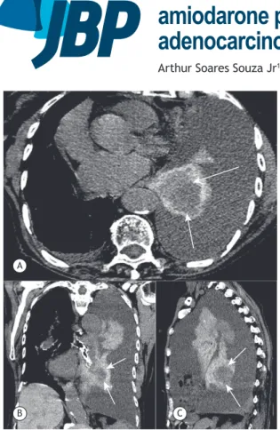 Figure 1. Axial (in A), coronal (in B), and sagittal (in C) chest  CT scans showing left pleural effusion and a high-density  collapsed lung containing a round hypodense mass (arrows)