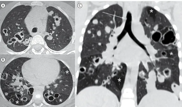 Figura 1. Paciente masculino, 6 anos. Imagens de TC Com cortes no plano axial ao nível dos lobos superiores (em A),  inferiores (em B) e no plano coronal (em C), mostrando nodulação na traqueia (seta branca), áreas de aprisionamento  aéreo esparsas por amb