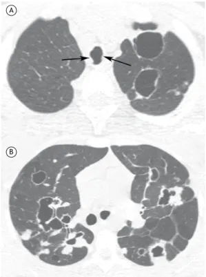 Figura 3. TC com cortes axiais ao nível dos lobos  superiores (em A) e abaixo da bifurcação brônquica (em  B), evidenciando nódulos sólidos e nódulos escavados em  ambos os pulmões, alguns desses com paredes espessas  e outros com paredes mais inas