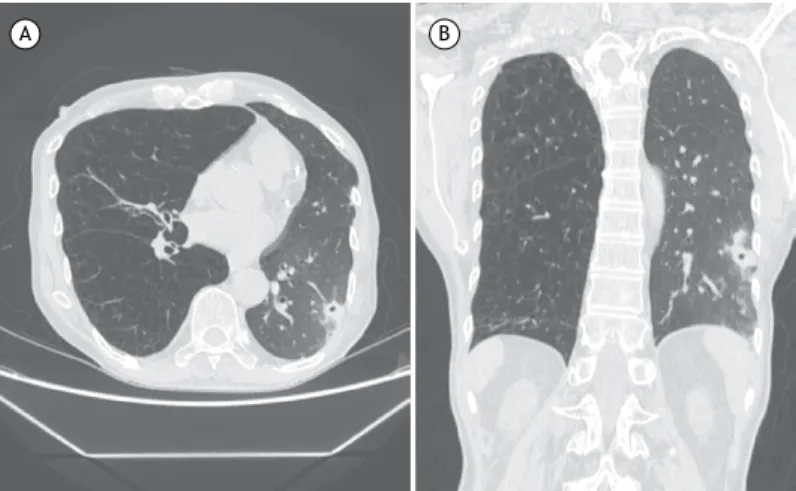 Figura 2. Tuberculose pulmonar em homem de 54 anos de idade submetido a transplante pulmonar esquerdo
