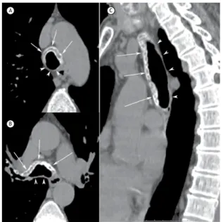 Figure 1. Axial CT slices (in A and B) and coronal CT  reconstruction (in C) showing diffuse thickening of the anterior  wall  of  the  trachea  and  main  bronchi,  with  calciications  (arrows)